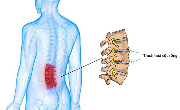 Đau lưng không cúi được có thể xảy ra do bệnh thoái hoá cột sống thắt lưng